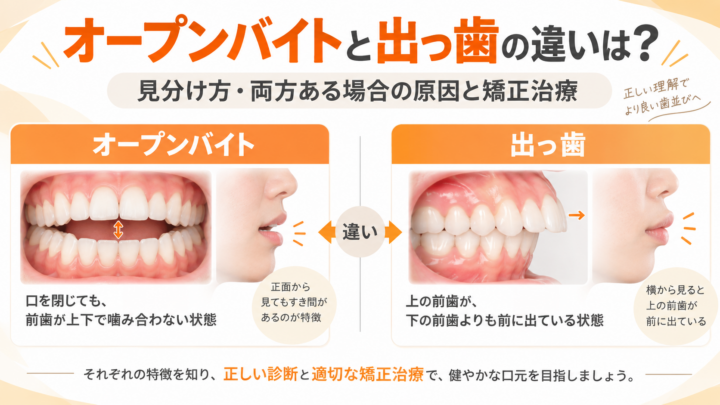 オープンバイトと出っ歯の違いは？見分け方・両方ある場合の原因と矯正治療を解説
