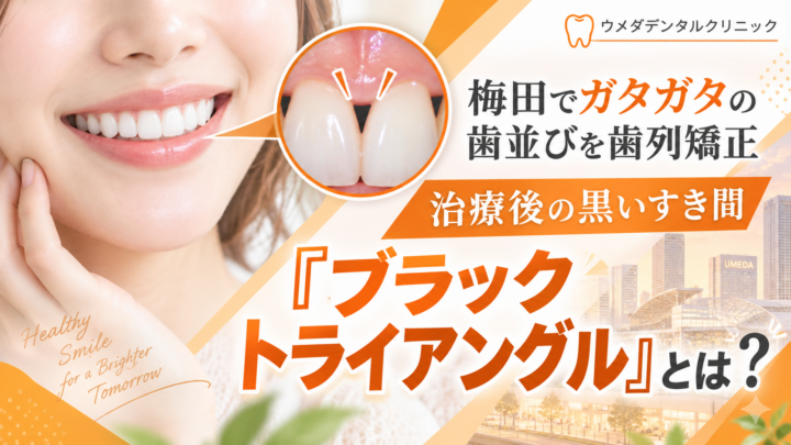 梅田でガタガタの歯並びを歯列矯正｜治療後の黒いすき間「ブラックトライアングル」とは？